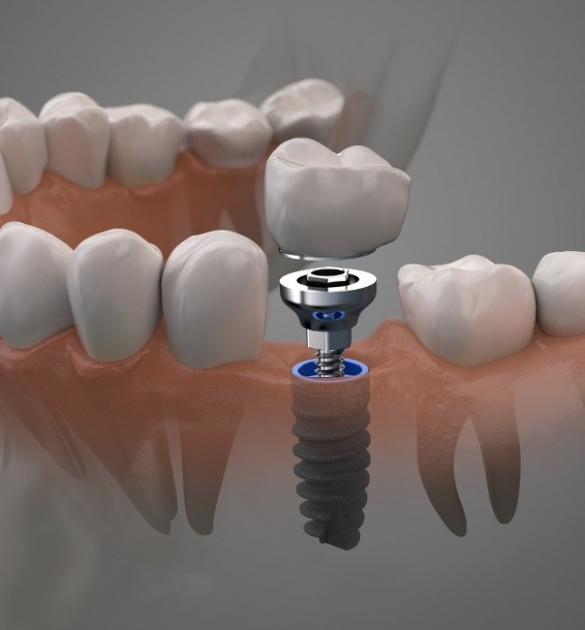 DENTAL IMPLANTS